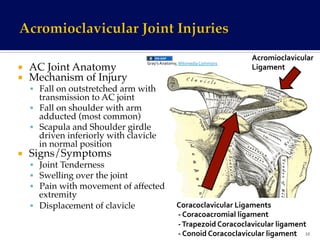 ¡  AC Joint Anatomy!
¡  Mechanism of Injury!
§  Fall on outstretched arm with
transmission to AC joint!
§  Fall on shoulder with arm
adducted (most common)!
§  Scapula and Shoulder girdle
driven inferiorly with clavicle
in normal position!
¡  Signs/Symptoms!
§  Joint Tenderness!
§  Swelling over the joint!
§  Pain with movement of affected
extremity!
§  Displacement of clavicle! Coracoclavicular	
  Ligaments	
  
	
  -­‐	
  Coracoacromial	
  ligament	
  
	
  -­‐	
  Trapezoid	
  Coracoclavicular	
  ligament	
  
	
  -­‐	
  Conoid	
  Coracoclavicular	
  ligament	
  
Acromioclavicular	
  	
  
Ligament	
  
10	
  
Gray’s	
  Anatomy,	
  Wikimedia	
  Commons	
  
 
