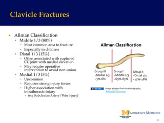 ¡  Allman Classiﬁcation!
§  Middle 1/3 (80%)!
▪  Most common area to fracture!
▪  Especially in children!
§  Distal 1/3 (15%)!
▪  Often associated with ruptured
CC joint with medial elevation!
▪  May require operative
intervention to avoid non-union!
§  Medial 1/3 (5%)!
▪  Uncommon!
▪  Requires strong injury forces!
▪  Higher association with
intrathoracic injury !
▪  (e.g Subclavian Artery/Vein injury)!
16	
  
Image	
  adapted	
  from	
  Anatomagraphy,	
  
Wikimedia	
  Commons	
  	
  
Group	
  III	
  
~Medial	
  1/3	
  
~3%-­‐6%	
  
Group	
  I	
  
~Middle	
  1/3	
  
~69%-­‐85%	
  
Group	
  II	
  
~Distal	
  1/3	
  
~12%-­‐28%	
  
Allman	
  Classiﬁcation	
  
 