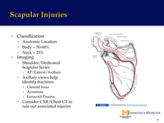 ¡  Classiﬁcation!
§  Anatomic Location!
§  Body = 50-60%!
§  Neck = 25%!
¡  Imaging!
§  Shoulder/Dedicated
Scapular Series!
▪  AP/Lateral/Axillary!
§  Axillary views help
identify fractures:!
▪  Glenoid fossa!
▪  Acromion!
▪  Coracoid Process!
§  Consider CXR/Chest CT to
rule out associated injuries!
20	
  
Gray’s	
  Anatomy,	
  Wikimedia	
  Commons	
  
 