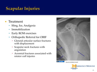 ¡  Treatment!
§  Sling, Ice, Analgesia!
§  Immobilization!
§  Early ROM exercises!
§  Orthopedic Referral for ORIF!
▪  Glenoid articular surface fractures
with displacement!
▪  Scapular neck fractures with
angulation!
▪  Acromial fractures associated with
rotator cuff injuries!
!
21	
  
Source	
  Undetermined	
  
 