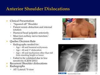 ¡  Clinical Presentation!
§  “Squared off” Shoulder!
§  Patient resists abduction and internal
rotation!
§  Humeral head palpable anteriorly!
§  Must test axillary nerve function/
sensation!
¡  Quebec Decision Rule!
§  Radiographs needed for:!
▪  Age > 40 and humeral ecchymosis!
▪  Age > 40 and 1st dislocation!
▪  Age < 40 and mechanism other than fall
from standing height or lower!
§  Failed to be validated due to low
sensitivity (CJEM 2011)!
¡  Recurrent Shoulder dislocations!
¡  Radiographs!
§  AP/Lateral/Y-view!
23	
  
Source	
  Undetermined	
  	
  
Source	
  Undetermined	
  	
  
 