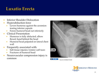 ¡  Inferior Shoulder Dislocation!
¡  Hyperabduction force !
¡  Levers humerus against the acromion
tearing inferior capsule!
¡  Forces humeral head out inferiorly!
¡  Clinical Presentation!
¡  Humerus is fully abducted, elbow
ﬂexed, hand behind the head!
¡  Humeral head palpated on lateral chest
wall!
¡  Frequently associated with:!
¡  Soft tissue injuries/rotator cuff tears!
¡  Fractures of humeral head!
¡  Neurovascular compression injury is
common!
25	
  
Source	
  Undetermined	
  
 