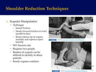 ¡  Scapular Manipulation!
§  Technique!
▪  Seated Position!
▪  Steady forward traction on wrist
parallel to ﬂoor!
▪  Rotate inferior tip of scapula
medially and superior aspect
laterally!
§  96% Success rate!
§  Requires two people!
§  Borders of scapula can be
difﬁcult to identify in obese
patients!
§  Rarely requires sedation!
29	
  
Source:	
  University	
  of	
  Hawaii	
  School	
  of	
  Medicine	
  	
  
Source:	
  University	
  of	
  Hawaii	
  School	
  of	
  Medicine	
  	
  
 