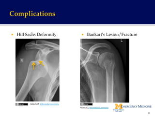 ¡  Hill Sachs Deformity! ¡  Bankart’s Lesion/Fracture!
http://www.mypacs.net/repos/mpv3_repo/viz/
full/18712/935613.jpg	
  
32	
  
Hellerhoﬀ,	
  Wikimedia	
  Commons	
  
RSatUSZ,	
  Wikimedia	
  Commons	
  
 