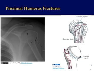 Fragments	
  of	
  Humerus	
  Head	
  
Articular	
  surface	
  of	
  humeral	
  head	
  
Greater	
  tubercle	
  
Lesser	
  tubercle	
  
Shaft	
  of	
  humerus	
  
35	
  
3	
  
1	
  
2	
  
James	
  Heilman,	
  MD,	
  Wikimedia	
  Commons	
  
Gray’s	
  Anatomy,	
  	
  
Wikimedia	
  Commons	
  
 