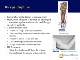 ¡  Proximal or distal biceps tendon rupture!
¡  Mechanism of Injury = Sudden or prolonged
contraction against resistance in middle aged
or elderly patients!
¡  Clinical Presentation!
§  “Snap” or “Pop” typically described!
§  Pain, swelling, tenderness over site of tendon
rupture!
§  Flexion of elbow = Mid-arm ball!
§  Loss of strength sometimes minimal!
§  X-rays to exclude avulsion fracture!
¡  ED Treatment!
§  Sling, Ice, Analgesia, Orthopedic referral!
§  Surgical repair for young, active patients!
38	
  
Patenthalse,	
  Wikimedia	
  Commons	
  
Gray’s	
  Anatomy,	
  
Wikimedia	
  Commons	
  
 