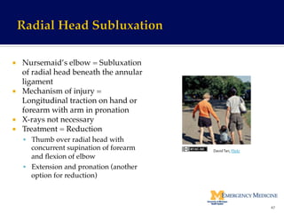 ¡  Nursemaid’s elbow = Subluxation
of radial head beneath the annular
ligament!
¡  Mechanism of injury =
Longitudinal traction on hand or
forearm with arm in pronation!
¡  X-rays not necessary!
¡  Treatment = Reduction!
§  Thumb over radial head with
concurrent supination of forearm
and ﬂexion of elbow!
§  Extension and pronation (another
option for reduction)!
47	
  
David	
  Tan,	
  Flickr	
  
 
