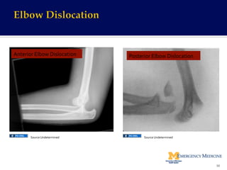 http://tw.myblog.yahoo.com/doctor-­‐-­‐anjenli/article?
mid=776&prev=778&next=774&l=f&ﬁd=79	
  
Anterior	
  Elbow	
  Dislocation	
   Posterior	
  Elbow	
  Dislocation	
  
50	
  
Source	
  Undetermined	
   Source	
  Undetermined	
  
 