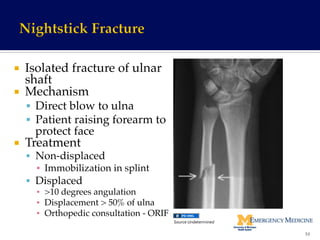 ¡  Isolated fracture of ulnar
shaft!
¡  Mechanism !
§  Direct blow to ulna!
§  Patient raising forearm to
protect face!
¡  Treatment!
§  Non-displaced!
▪  Immobilization in splint!
§  Displaced !
▪  >10 degrees angulation!
▪  Displacement > 50% of ulna!
▪  Orthopedic consultation - ORIF!
53	
  
Source	
  Undetermined	
  
 