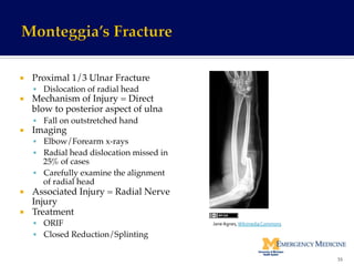¡  Proximal 1/3 Ulnar Fracture!
§  Dislocation of radial head!
¡  Mechanism of Injury = Direct
blow to posterior aspect of ulna!
§  Fall on outstretched hand!
¡  Imaging !
§  Elbow/Forearm x-rays!
§  Radial head dislocation missed in
25% of cases!
§  Carefully examine the alignment
of radial head!
¡  Associated Injury = Radial Nerve
Injury!
¡  Treatment !
§  ORIF !
§  Closed Reduction/Splinting !
55	
  
Jane	
  Agnes,	
  Wikimedia	
  Commons	
  
 