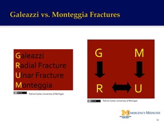 Galeazzi	
  
Radial	
  Fracture	
  
Ulnar	
  Fracture	
  
Monteggia	
  
G	
   M	
  
U	
  R	
  
56	
  
Patrick	
  Carter,	
  University	
  of	
  Michigan	
  
Patrick	
  Carter,	
  University	
  of	
  Michigan	
  
 