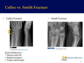 ¡  Colles Fracture !! ¡  Smith Fracture!
Goals	
  of	
  Reduction:	
  
*	
  	
  Restore	
  volar	
  tilt	
  
*	
  	
  Radial	
  Inclination	
  
*	
  	
  Proper	
  radial	
  length	
   59	
  
Lucien	
  Monﬁls,	
  Wikimedia	
  Commons	
  	
  
Source	
  Undetermined	
  
 