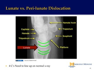 ¡  4 C’s Need to line up on normal x-ray!
Lunate	
  
69	
  
Source	
  Undetermined	
  
 