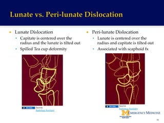 ¡  Lunate Dislocation!
§  Capitate is centered over the
radius and the lunate is tilted out!
§  Spilled Tea cup deformity!
¡  Peri-lunate Dislocation!
§  Lunate is centered over the
radius and capitate is tilted out!
§  Associated with scaphoid fx!
70	
  
Source:	
  
Radiology	
  Assistant	
  Source:	
  
Radiology	
  Assistant	
  
 
