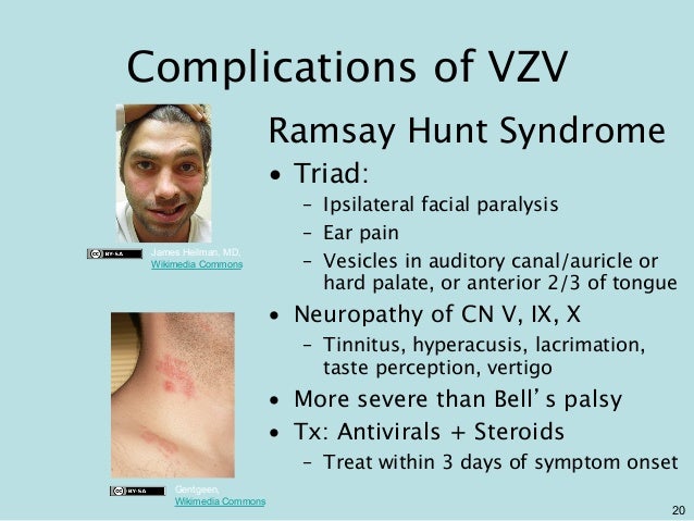 GEMC: Herpes Zoster: Resident Training