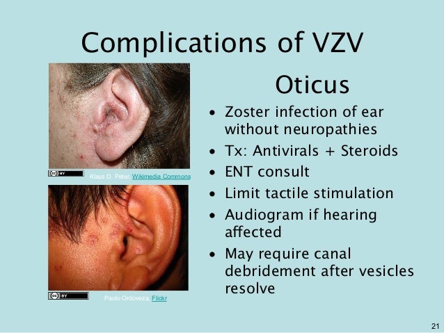Gemc Herpes Zoster Resident Training