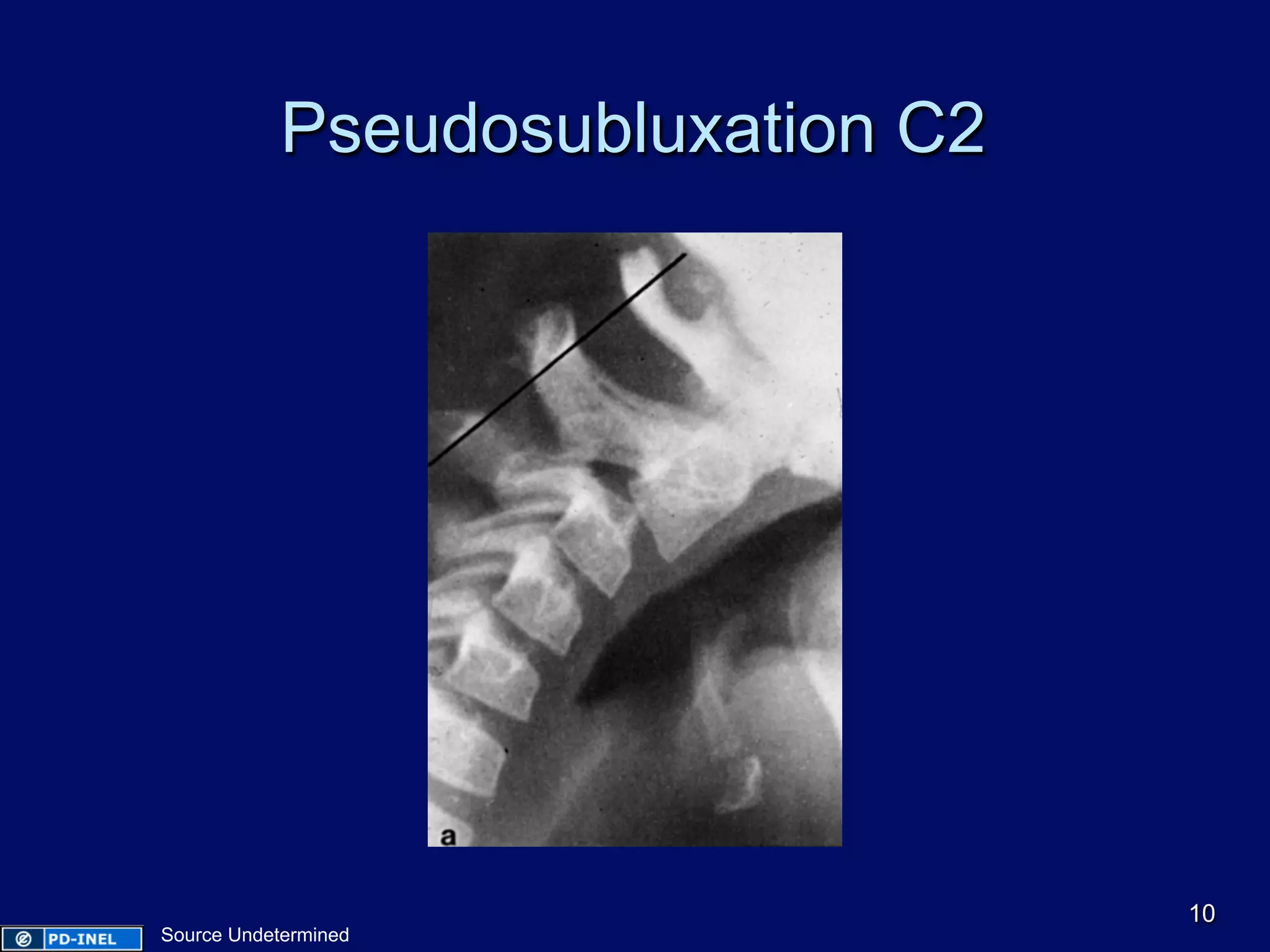 Pseudosubluxation C2
10
Source Undetermined
 