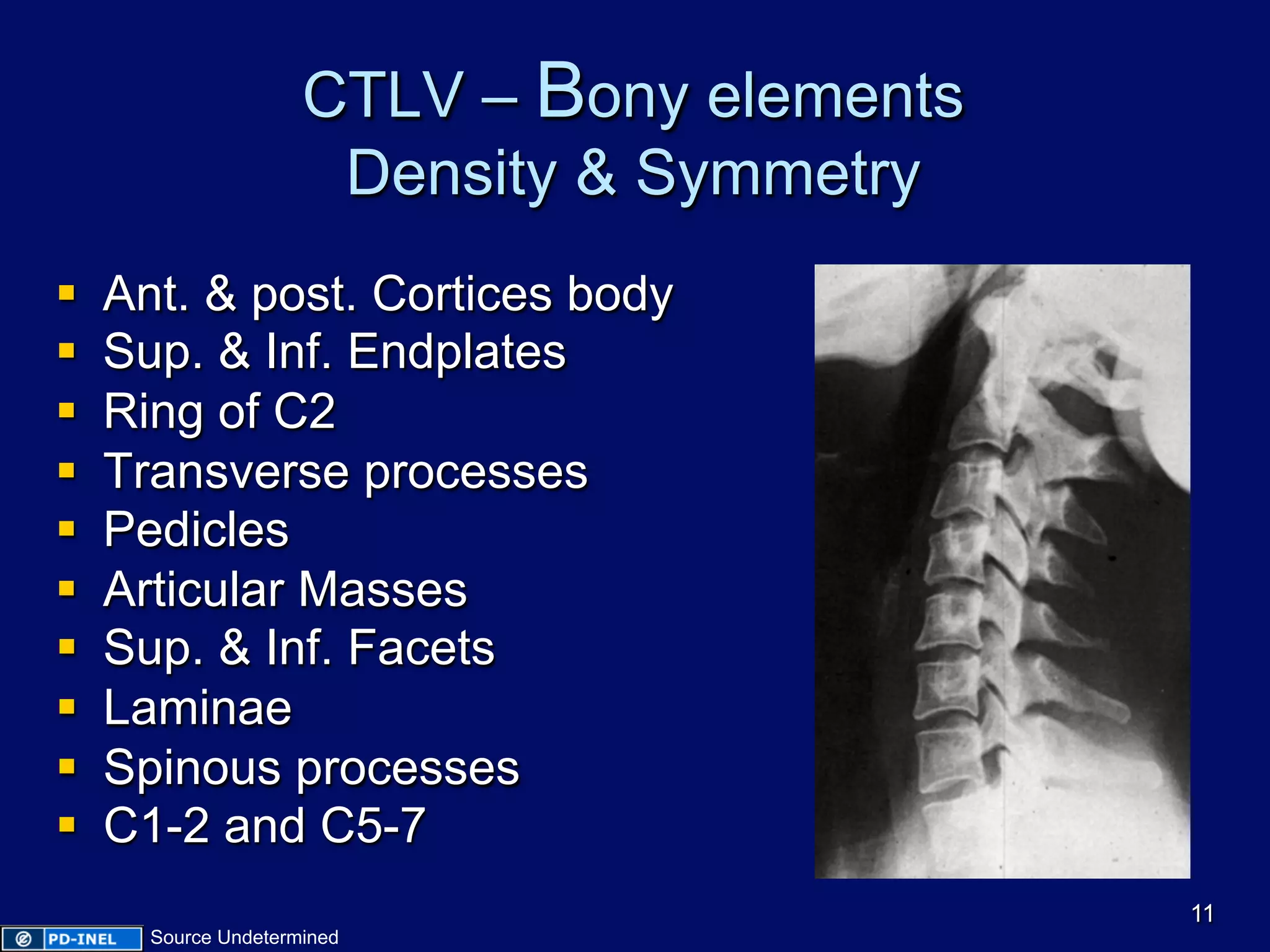 CTLV – Bony elements
Density & Symmetry
§  Ant. & post. Cortices body
§  Sup. & Inf. Endplates
§  Ring of C2
§  Transverse processes
§  Pedicles
§  Articular Masses
§  Sup. & Inf. Facets
§  Laminae
§  Spinous processes
§  C1-2 and C5-7
11
Source Undetermined
 
