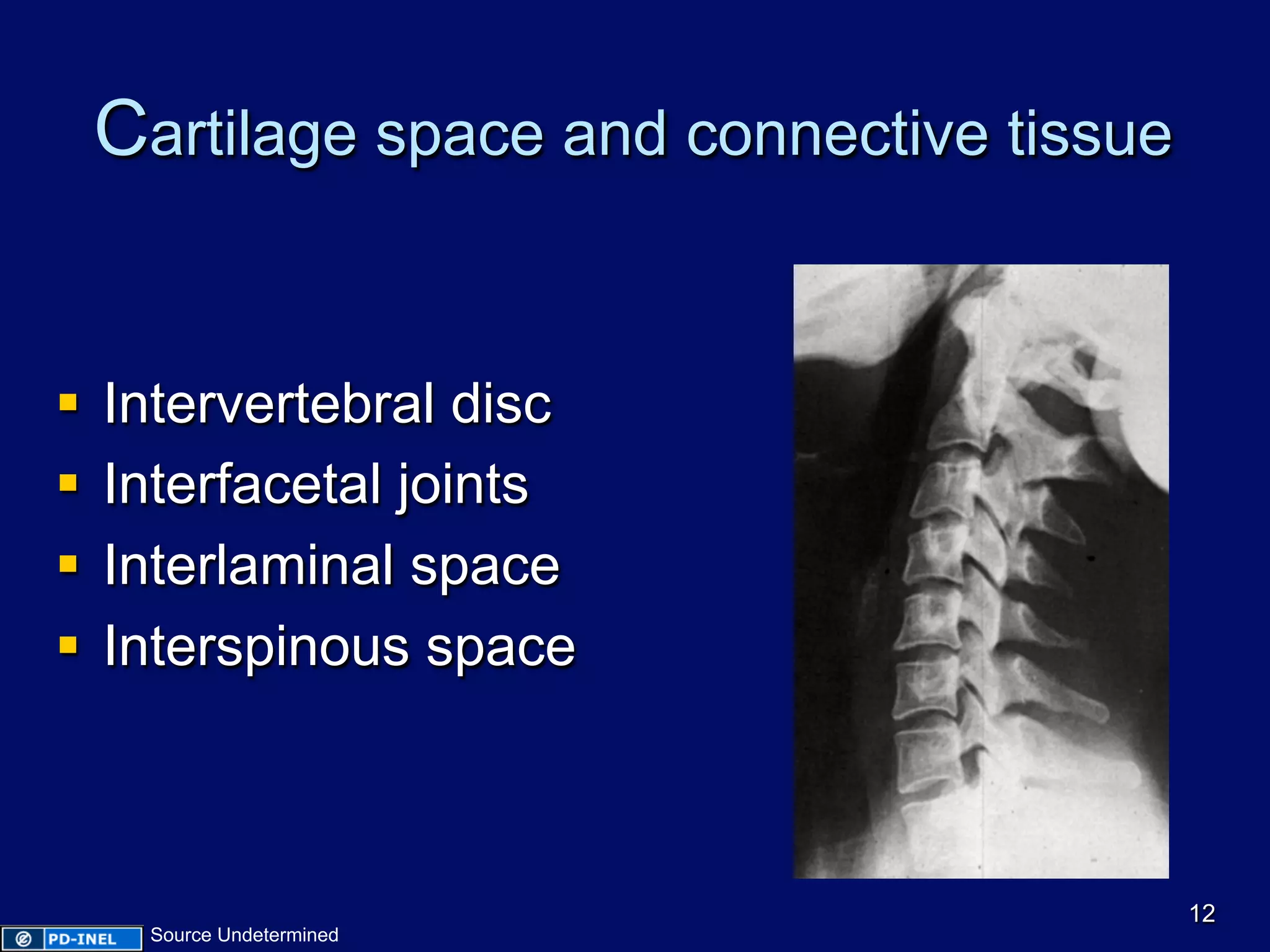 Cartilage space and connective tissue
§  Intervertebral disc
§  Interfacetal joints
§  Interlaminal space
§  Interspinous space
12
Source Undetermined
 