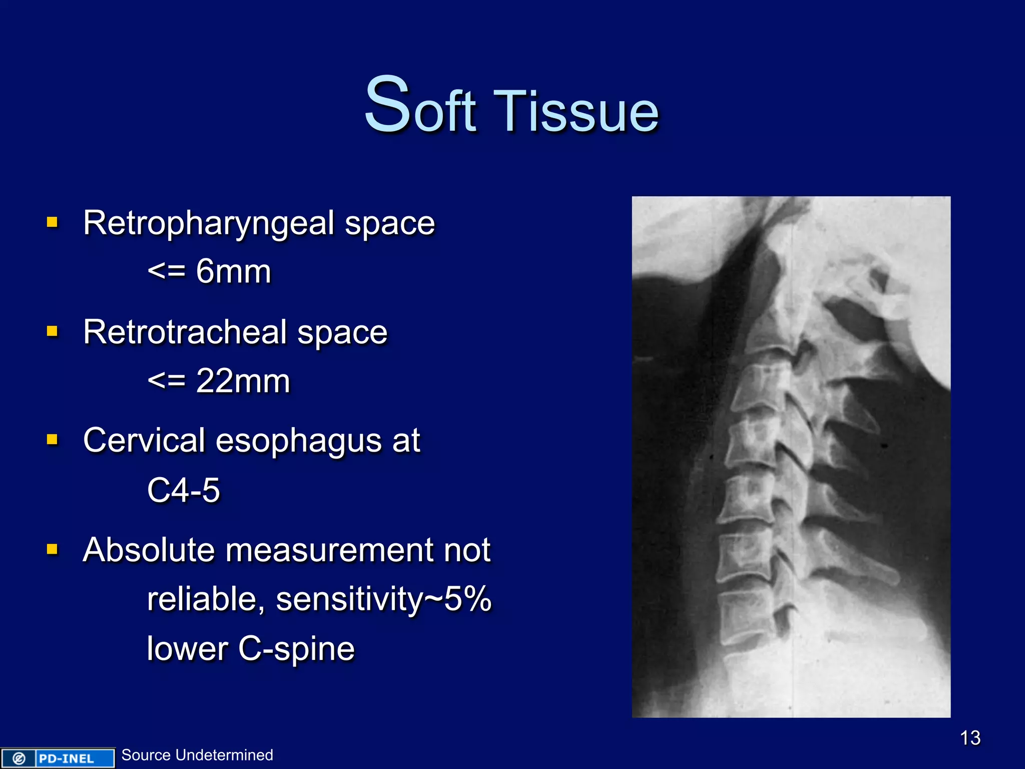 Soft Tissue
§  Retropharyngeal space
<= 6mm
§  Retrotracheal space
<= 22mm
§  Cervical esophagus at
C4-5
§  Absolute measurement not
reliable, sensitivity~5%
lower C-spine
13
Source Undetermined
 