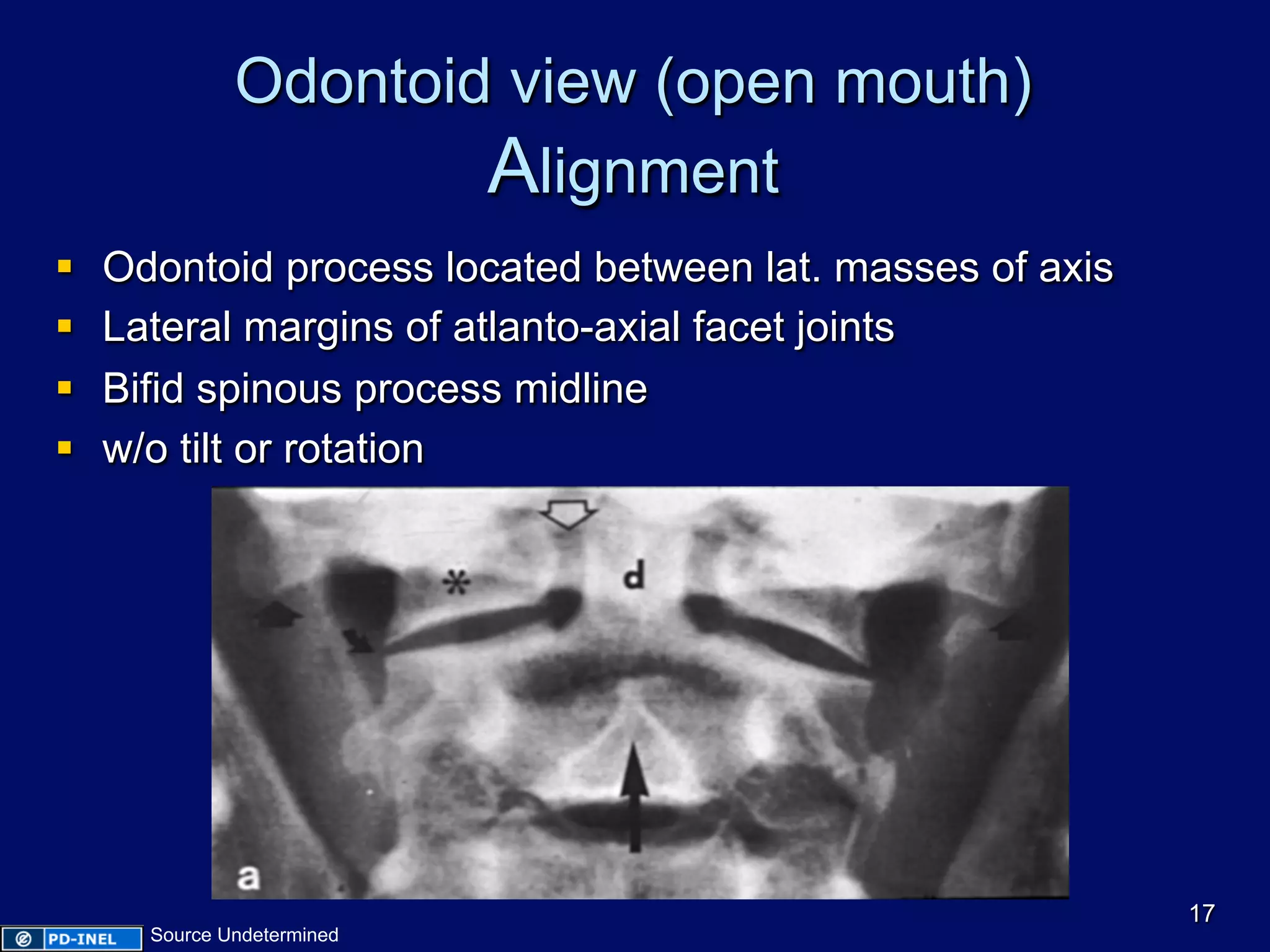 Odontoid view (open mouth)
Alignment
§  Odontoid process located between lat. masses of axis
§  Lateral margins of atlanto-axial facet joints
§  Bifid spinous process midline
§  w/o tilt or rotation
17
Source Undetermined
 