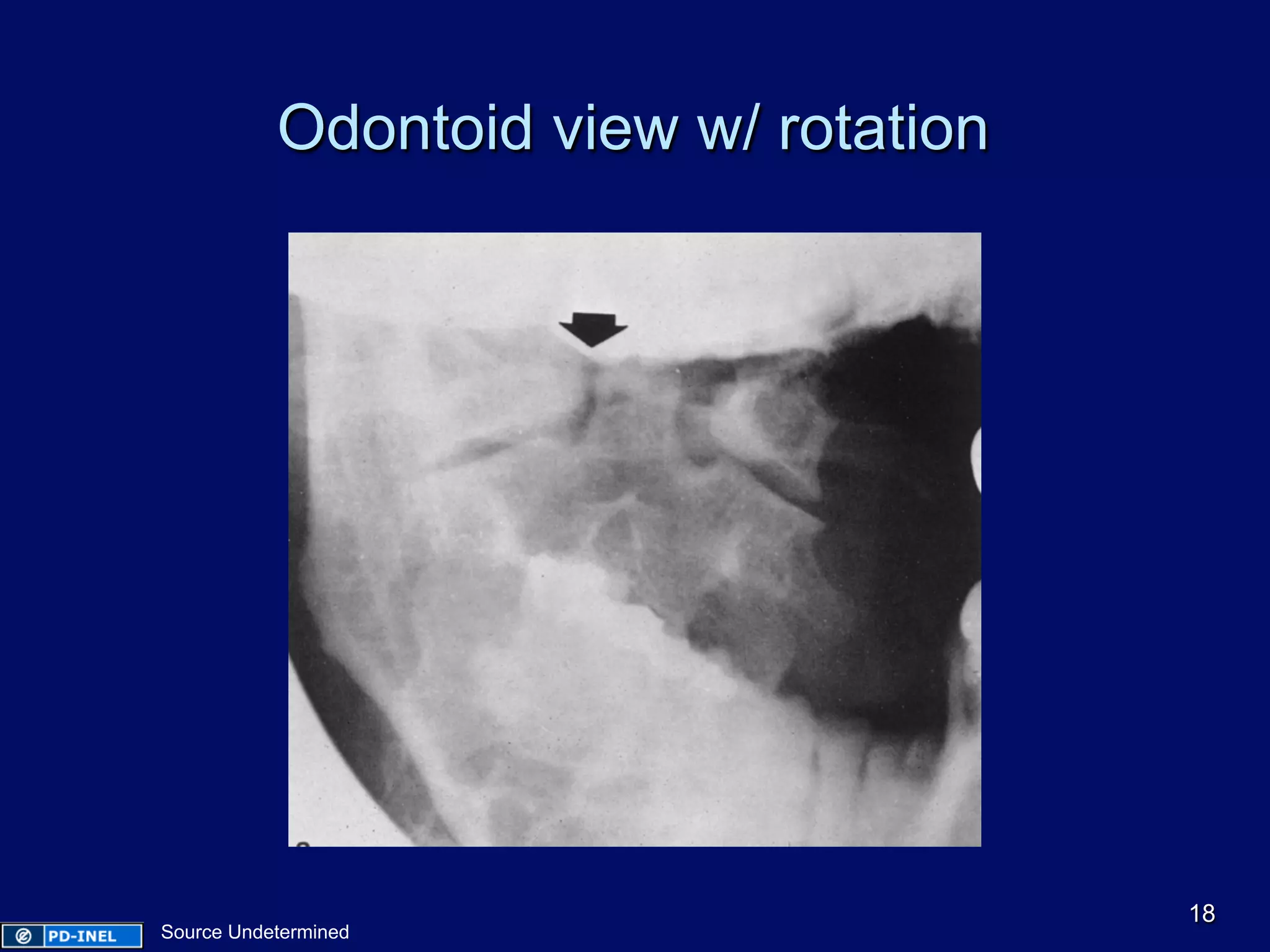 Odontoid view w/ rotation
18
Source Undetermined
 