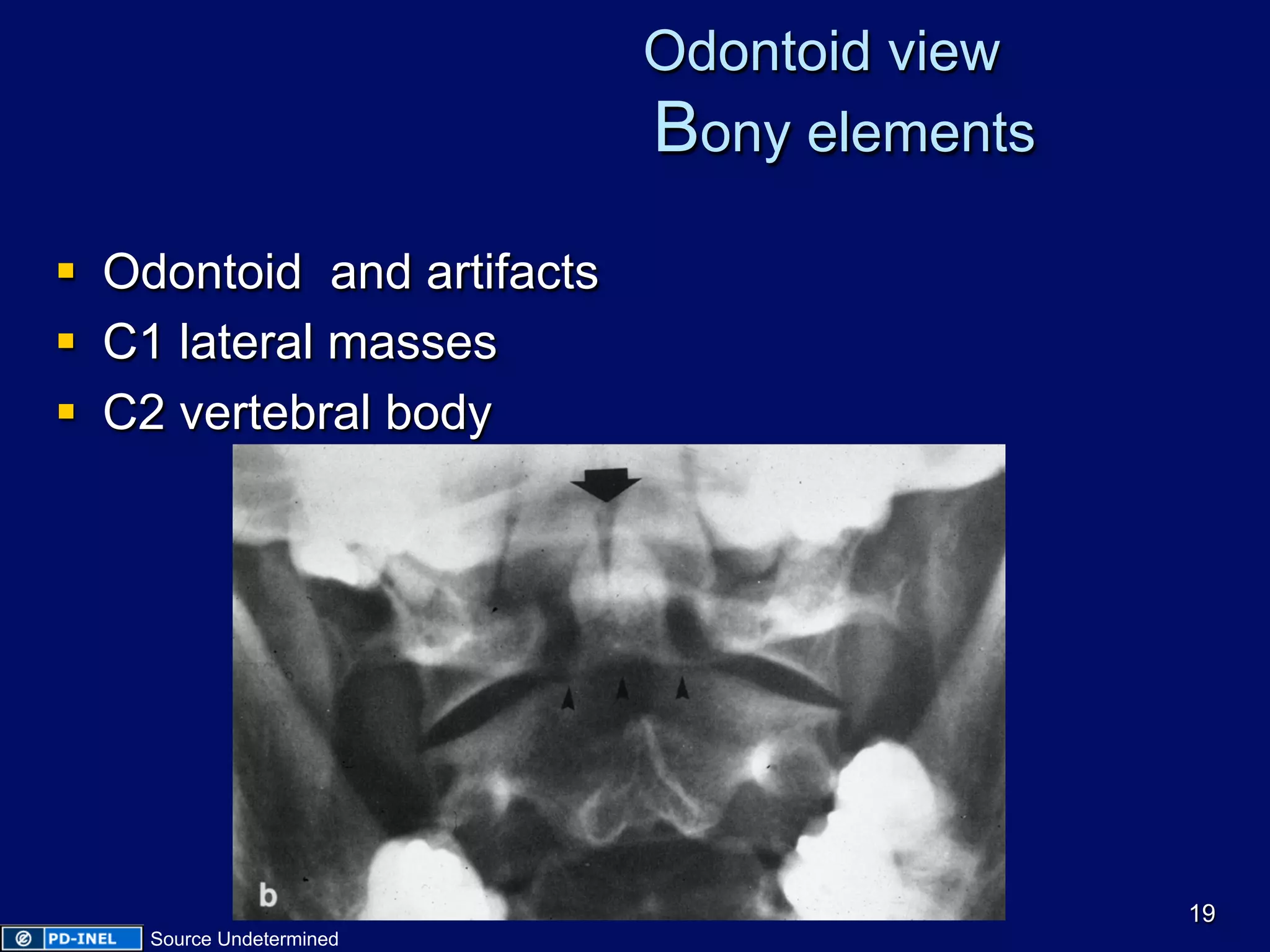 Odontoid view
Bony elements
§  Odontoid and artifacts
§  C1 lateral masses
§  C2 vertebral body
19
Source Undetermined
 