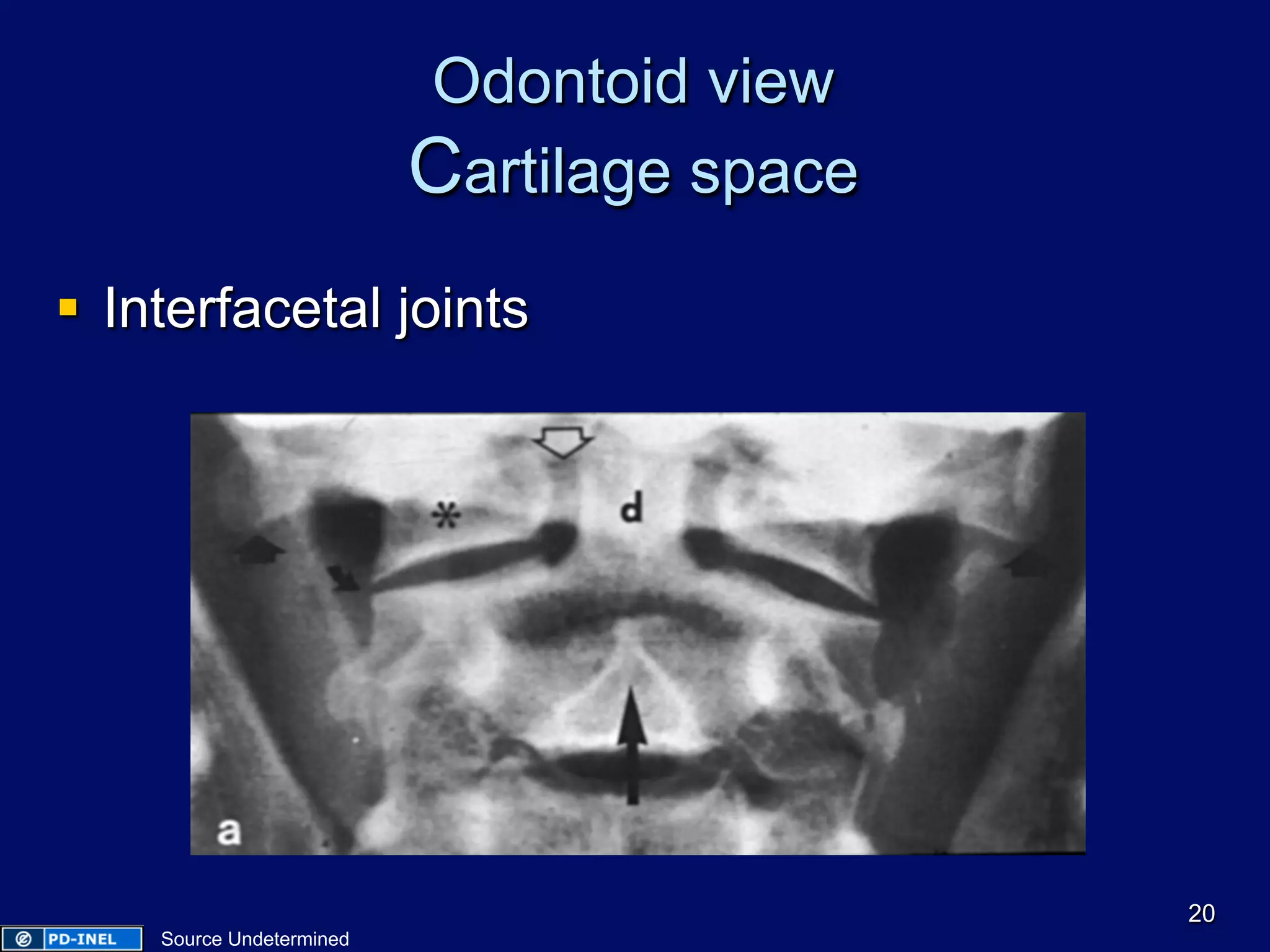 Odontoid view
Cartilage space
§  Interfacetal joints
20
Source Undetermined
 