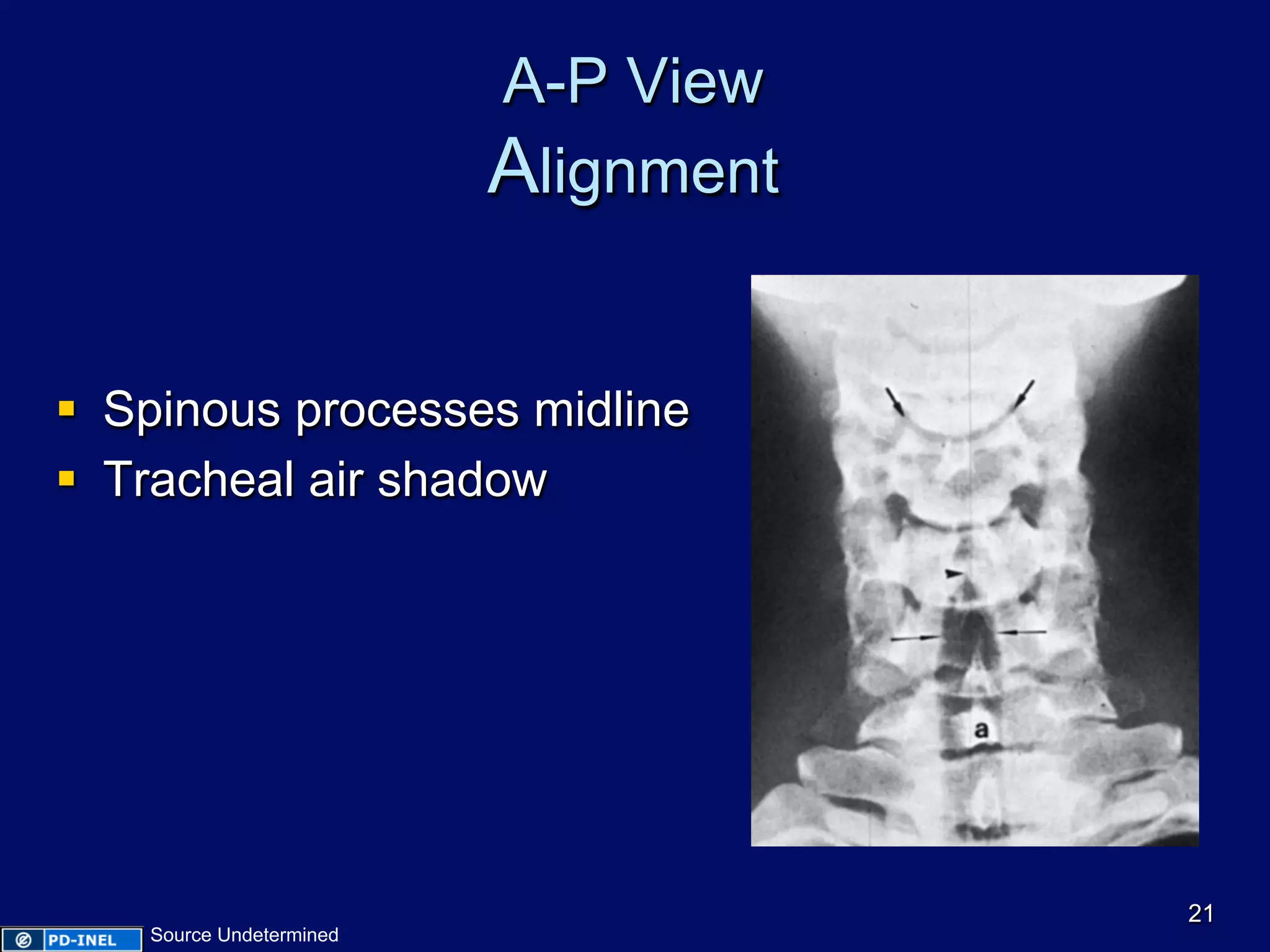 A-P View
Alignment
§  Spinous processes midline
§  Tracheal air shadow
21
Source Undetermined
 