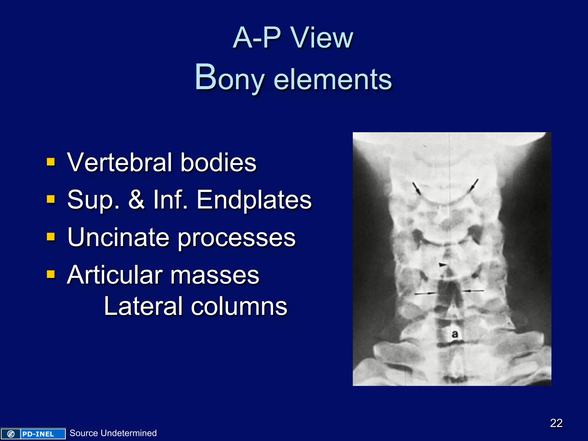 A-P View
Bony elements
§  Vertebral bodies
§  Sup. & Inf. Endplates
§  Uncinate processes
§  Articular masses
Lateral columns
22
Source Undetermined
 