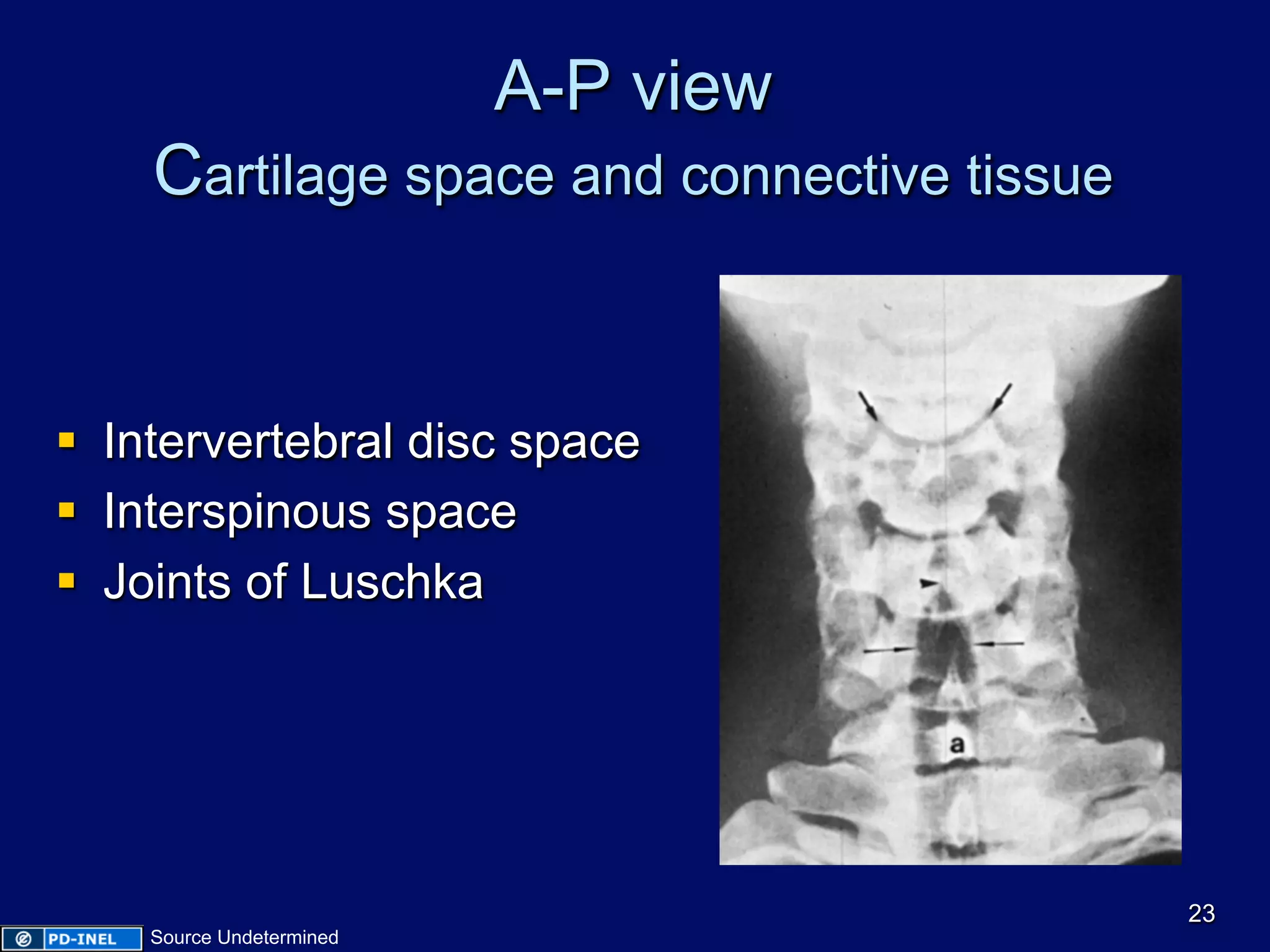 A-P view
Cartilage space and connective tissue
§  Intervertebral disc space
§  Interspinous space
§  Joints of Luschka
23
Source Undetermined
 