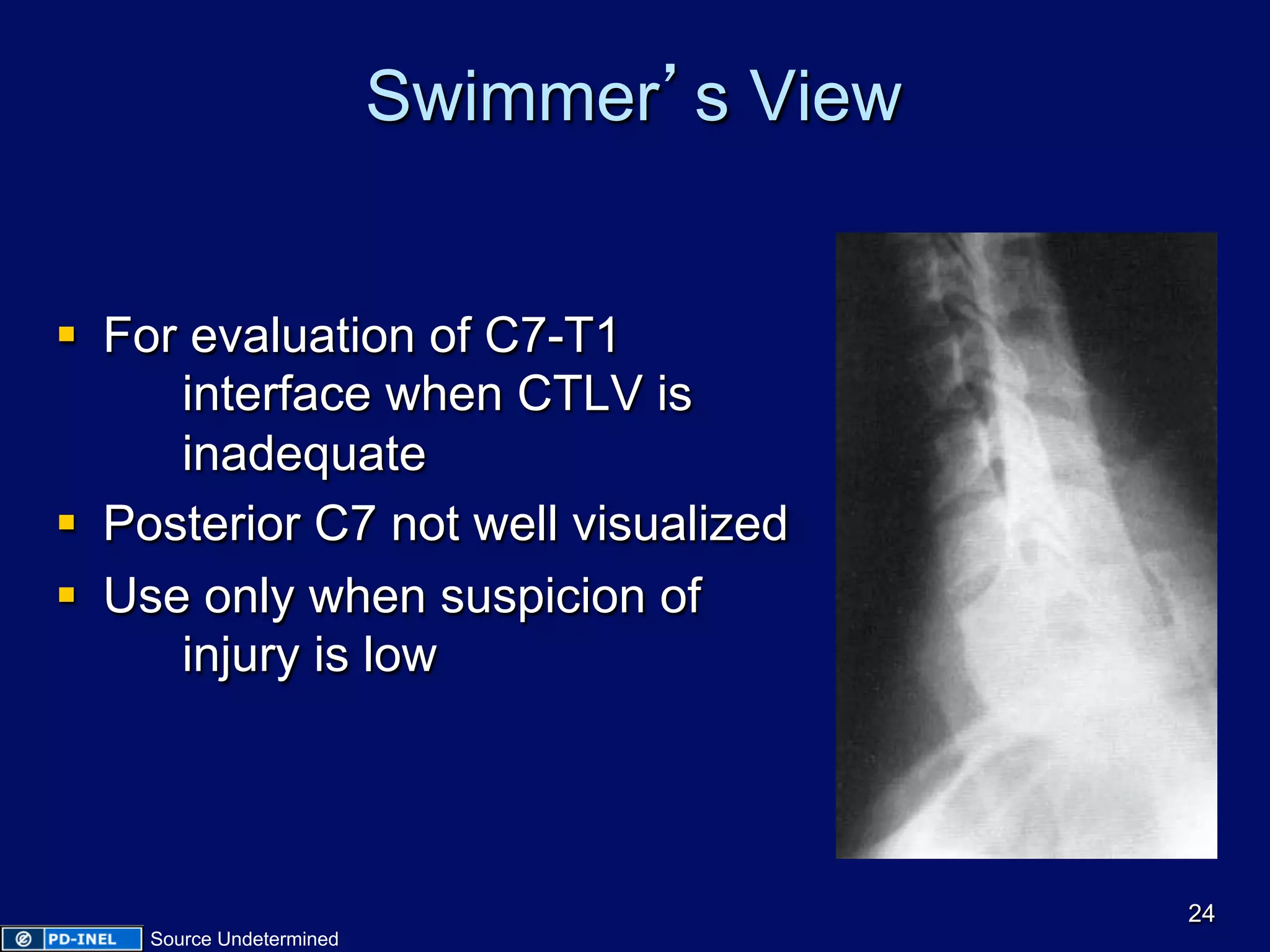 Swimmer’s View
§  For evaluation of C7-T1
interface when CTLV is
inadequate
§  Posterior C7 not well visualized
§  Use only when suspicion of
injury is low
24
Source Undetermined
 