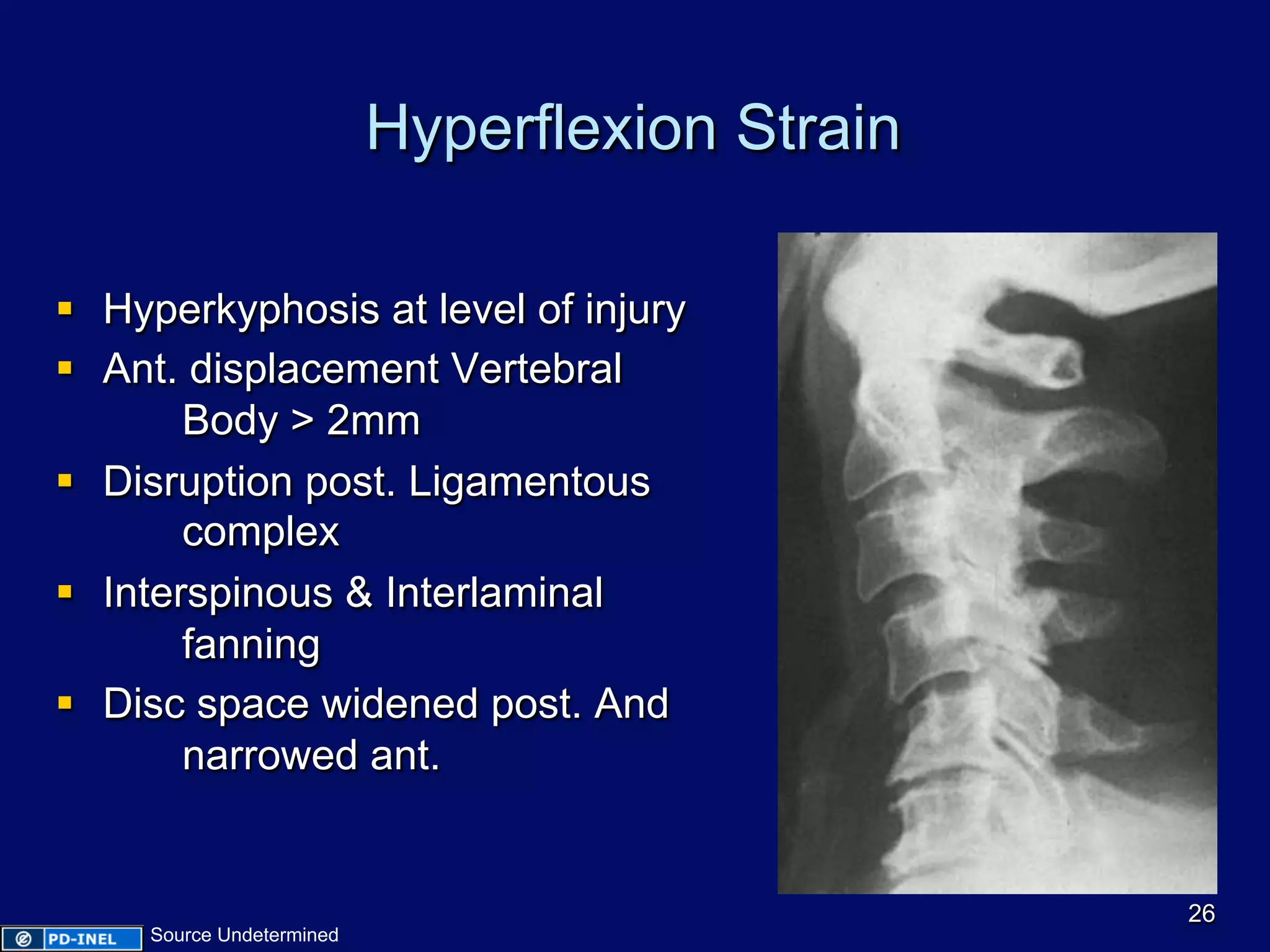 Hyperflexion Strain
§  Hyperkyphosis at level of injury
§  Ant. displacement Vertebral
Body > 2mm
§  Disruption post. Ligamentous
complex
§  Interspinous & Interlaminal
fanning
§  Disc space widened post. And
narrowed ant.
26
Source Undetermined
 