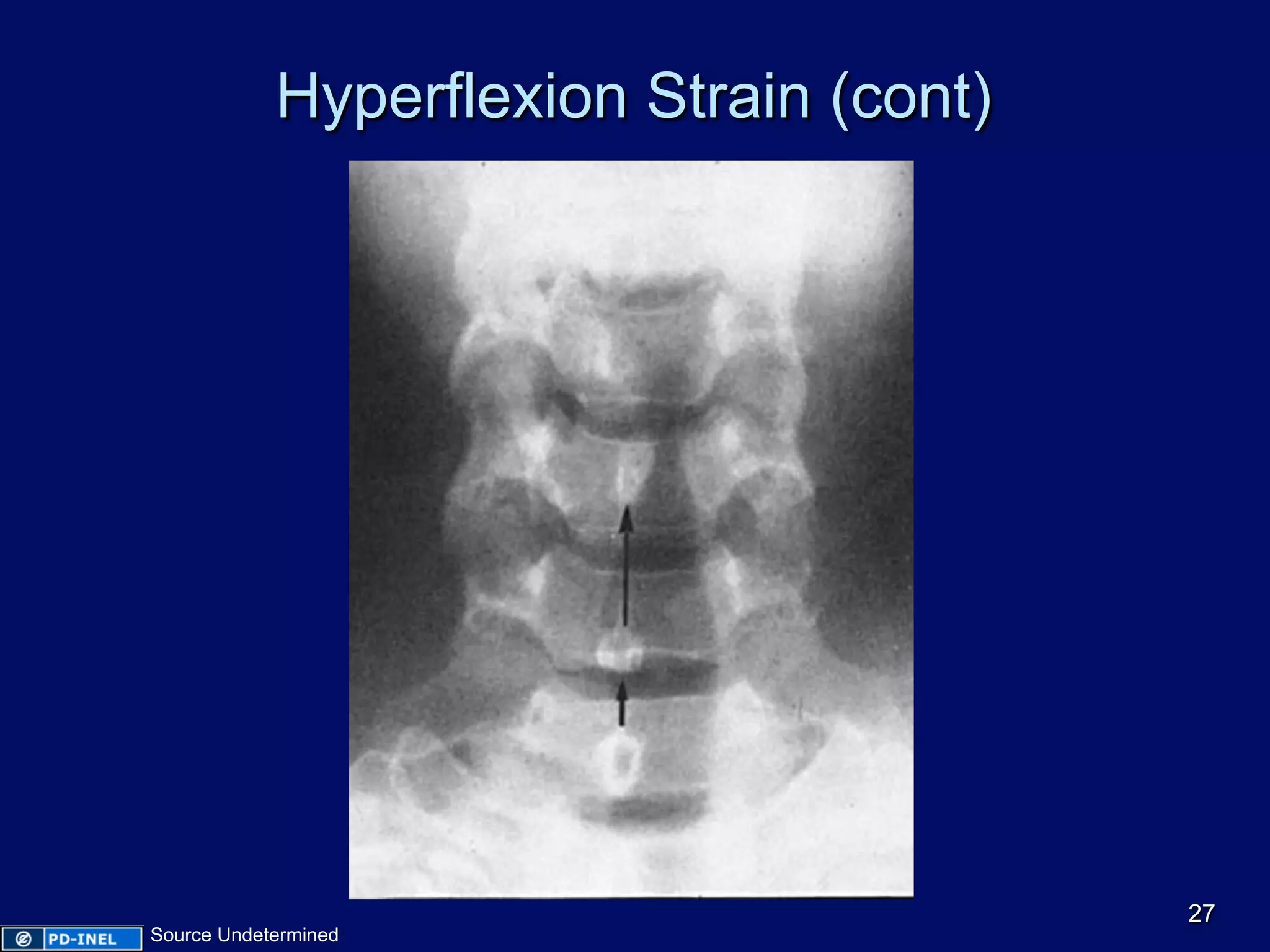 Hyperflexion Strain (cont)
27
Source Undetermined
 