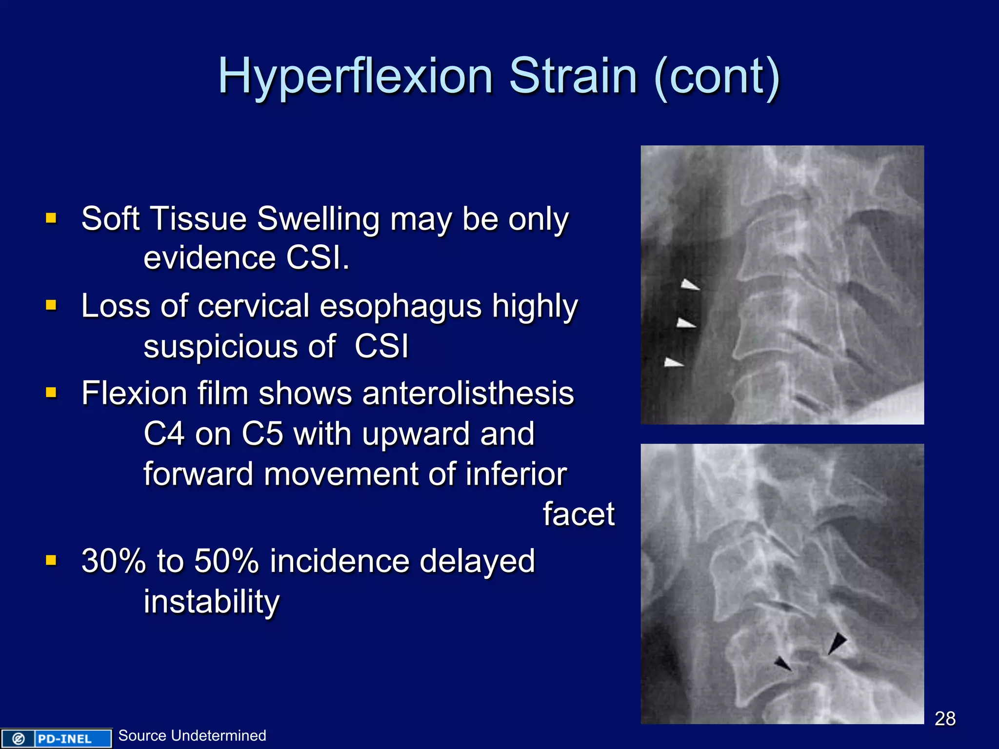 Hyperflexion Strain (cont)
§  Soft Tissue Swelling may be only
evidence CSI.
§  Loss of cervical esophagus highly
suspicious of CSI
§  Flexion film shows anterolisthesis
C4 on C5 with upward and
forward movement of inferior
facet
§  30% to 50% incidence delayed
instability
28
Source Undetermined
 