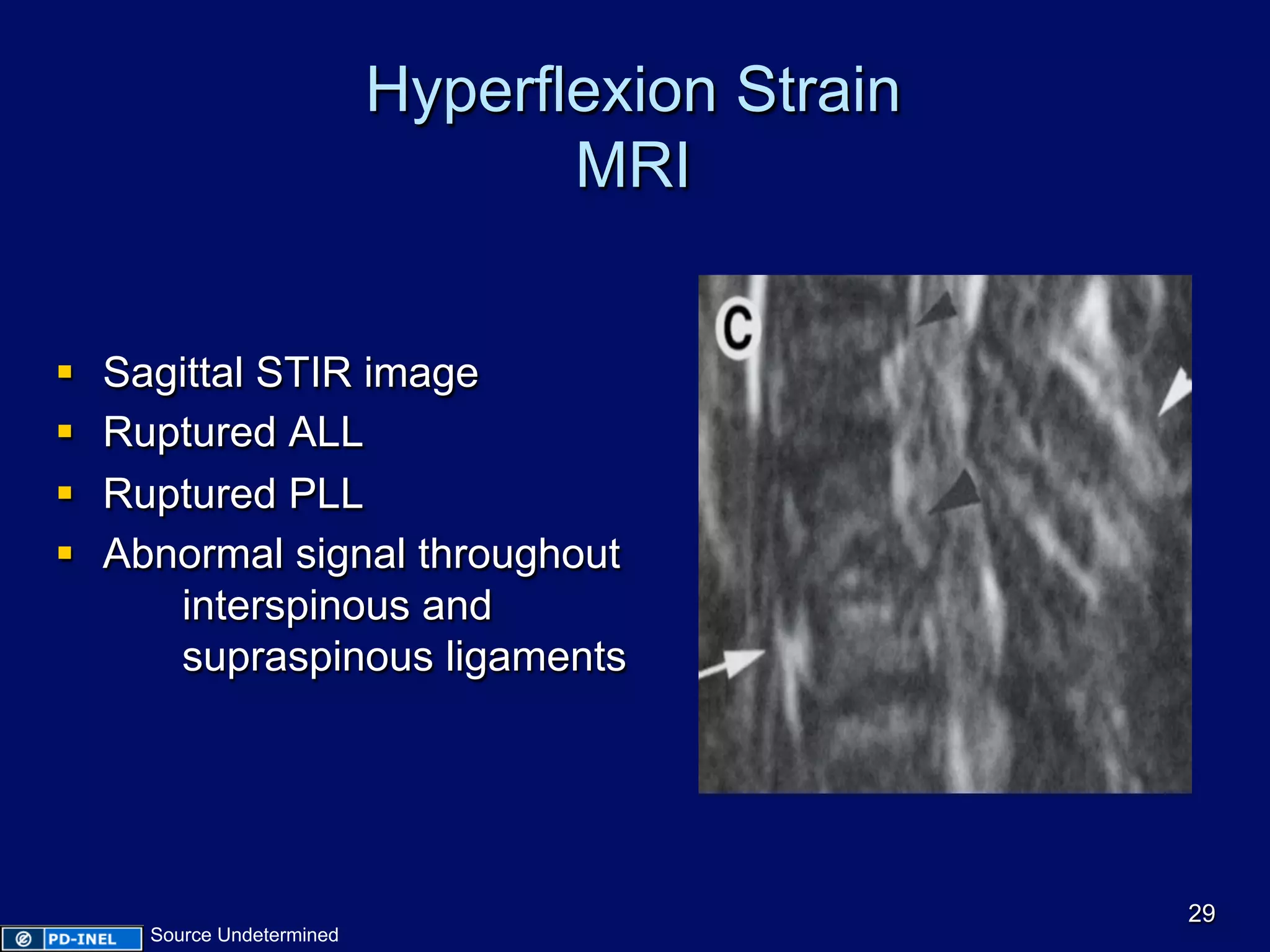 Hyperflexion Strain
MRI
§  Sagittal STIR image
§  Ruptured ALL
§  Ruptured PLL
§  Abnormal signal throughout
interspinous and
supraspinous ligaments
29
Source Undetermined
 
