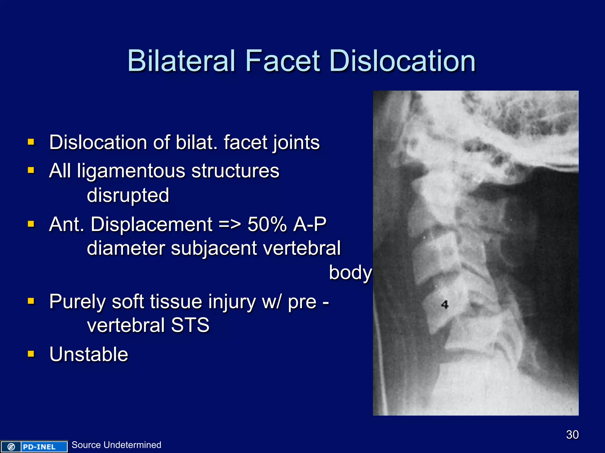Bilateral Facet Dislocation
§  Dislocation of bilat. facet joints
§  All ligamentous structures
disrupted
§  Ant. Displacement => 50% A-P
diameter subjacent vertebral
body
§  Purely soft tissue injury w/ pre -
vertebral STS
§  Unstable
30
Source Undetermined
 