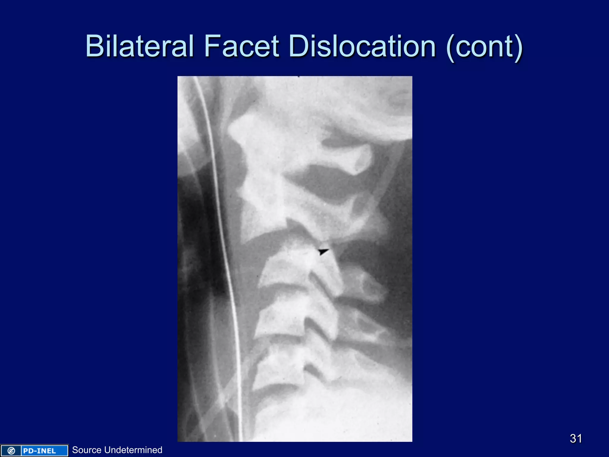Bilateral Facet Dislocation (cont)
31
Source Undetermined
 