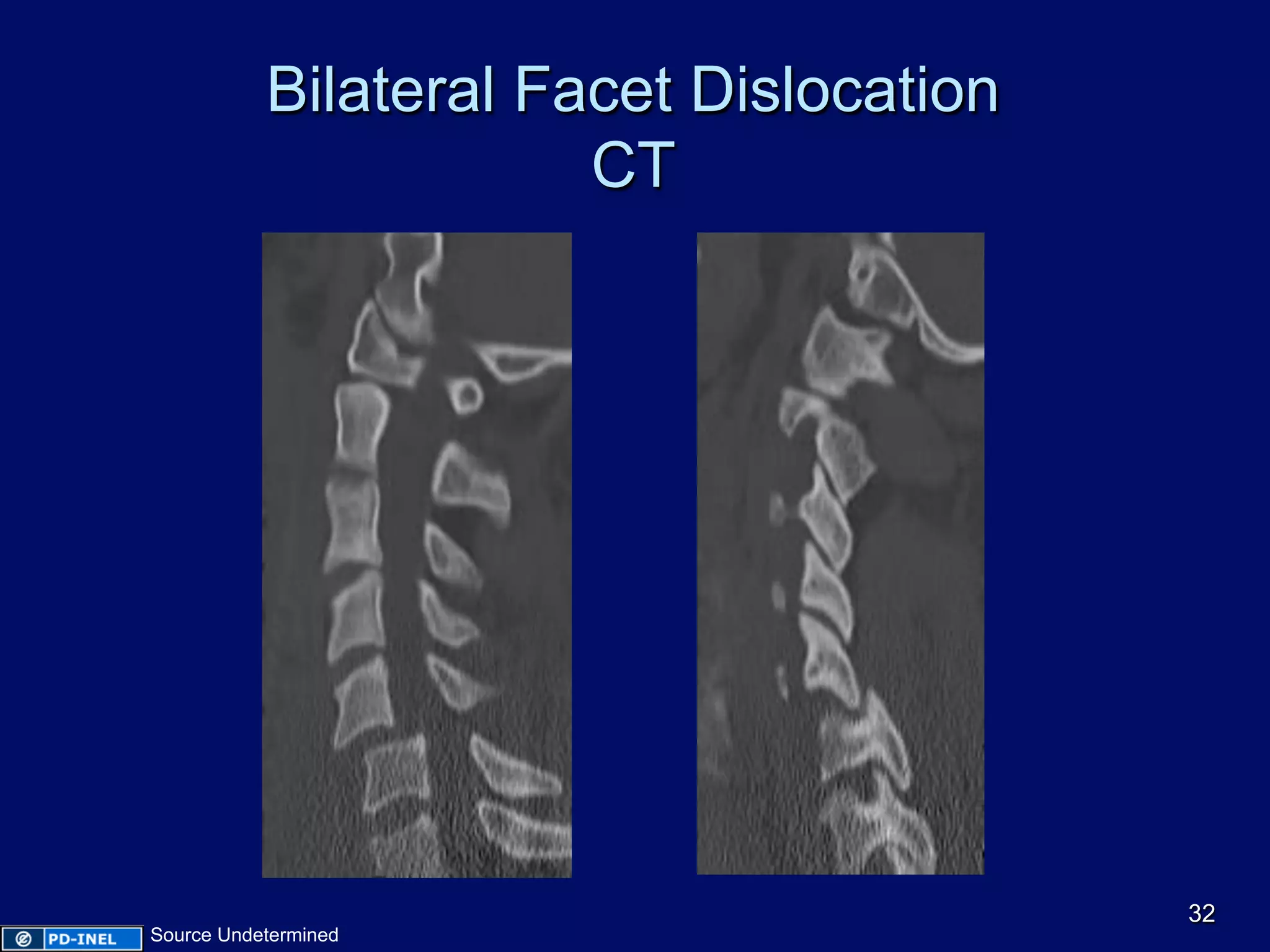 Bilateral Facet Dislocation
CT
32
Source Undetermined
 