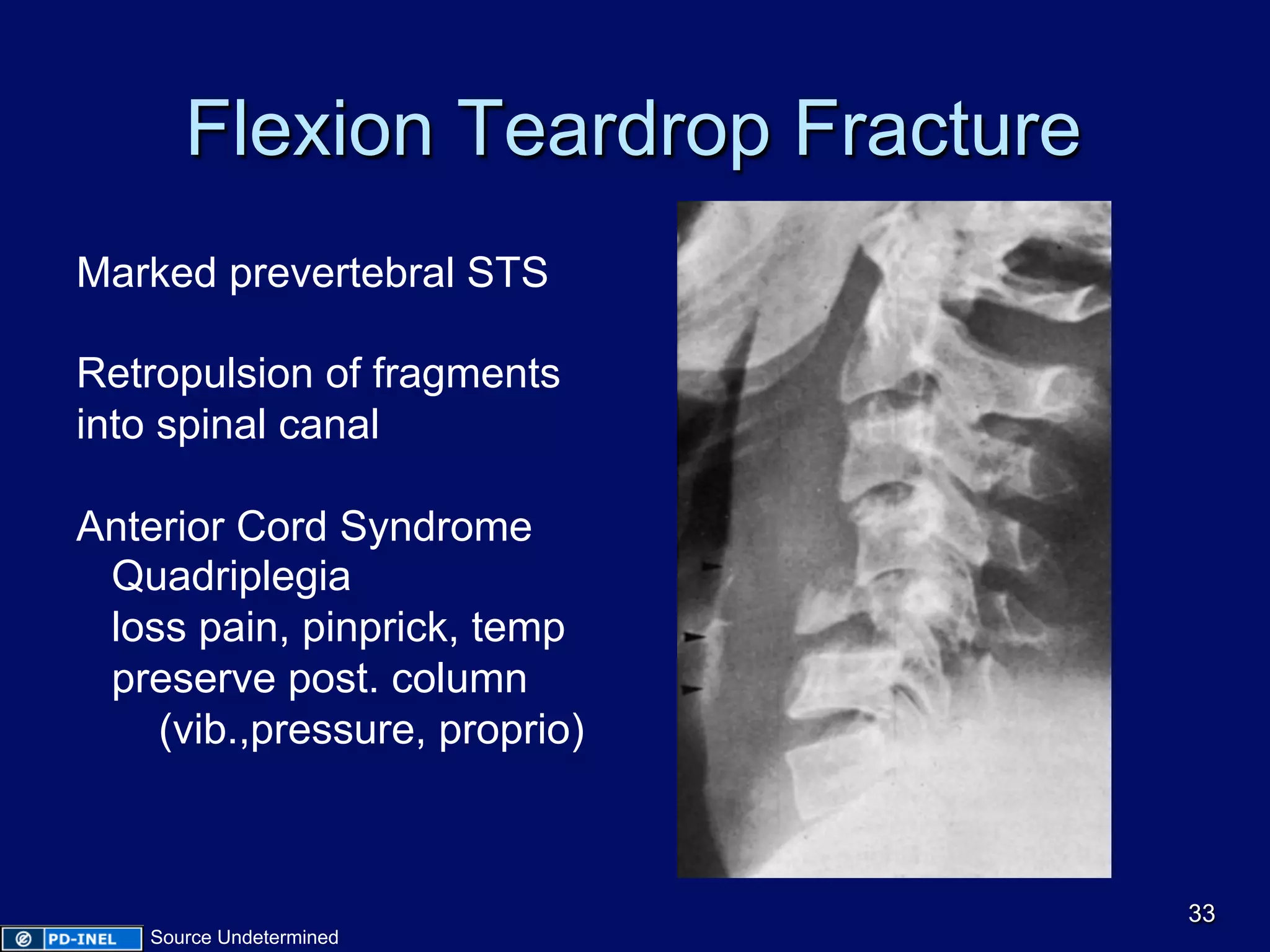 Flexion Teardrop Fracture
Marked prevertebral STS
Retropulsion of fragments
into spinal canal
Anterior Cord Syndrome
Quadriplegia
loss pain, pinprick, temp
preserve post. column
(vib.,pressure, proprio)
33
Source Undetermined
 