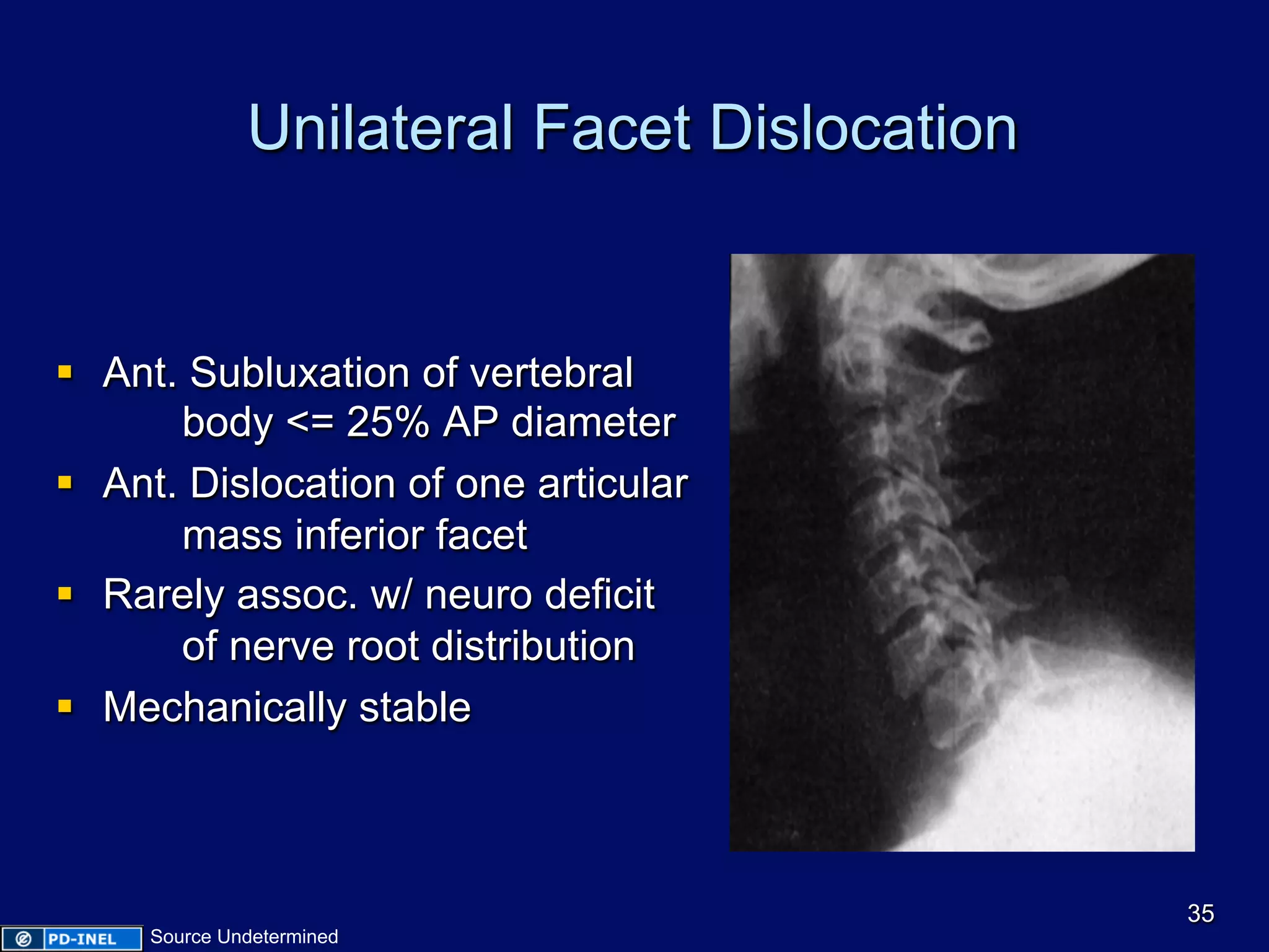 Unilateral Facet Dislocation
§  Ant. Subluxation of vertebral
body <= 25% AP diameter
§  Ant. Dislocation of one articular
mass inferior facet
§  Rarely assoc. w/ neuro deficit
of nerve root distribution
§  Mechanically stable
35
Source Undetermined
 