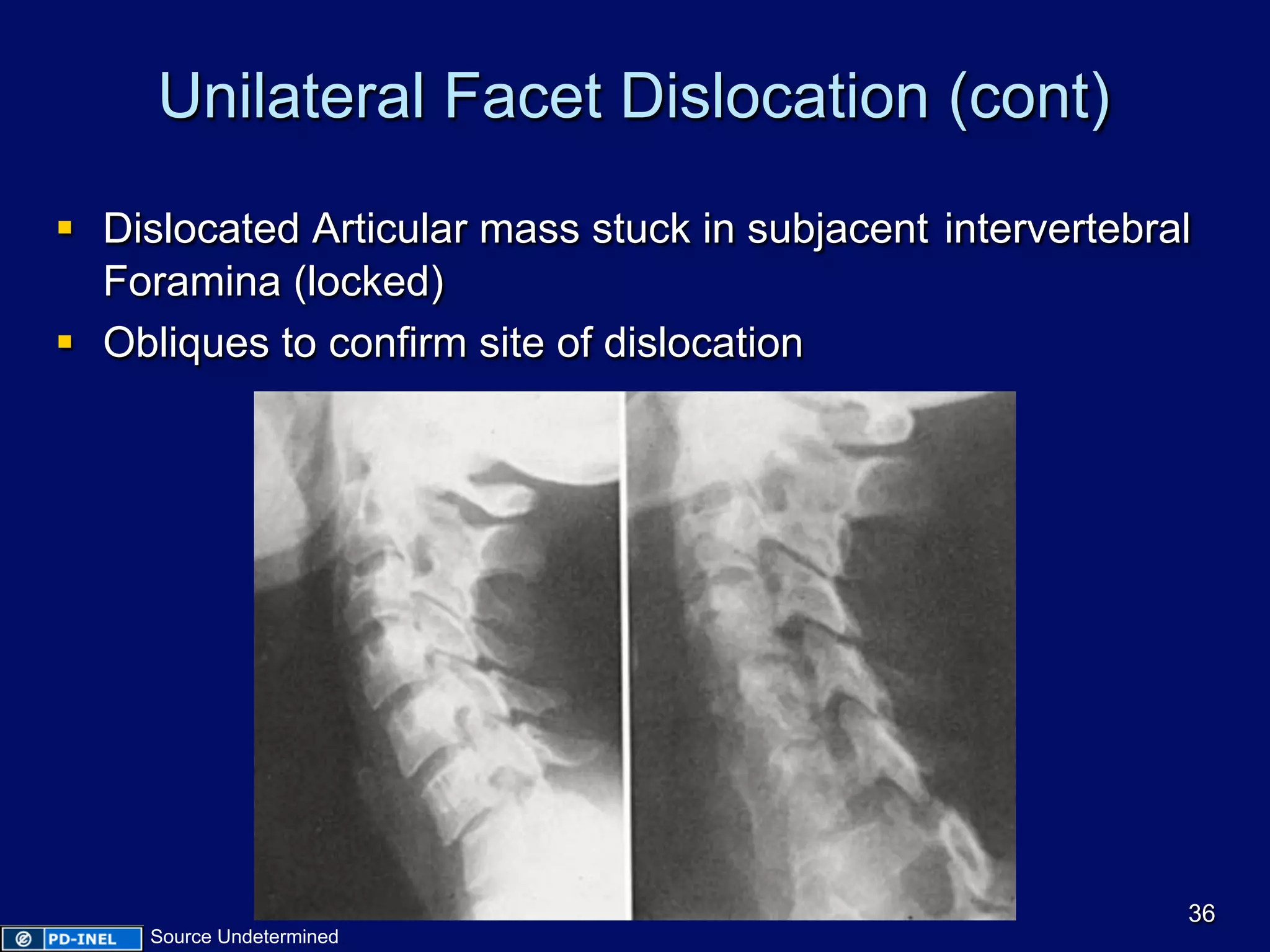 Unilateral Facet Dislocation (cont)
§  Dislocated Articular mass stuck in subjacent intervertebral
Foramina (locked)
§  Obliques to confirm site of dislocation
36
Source Undetermined
 