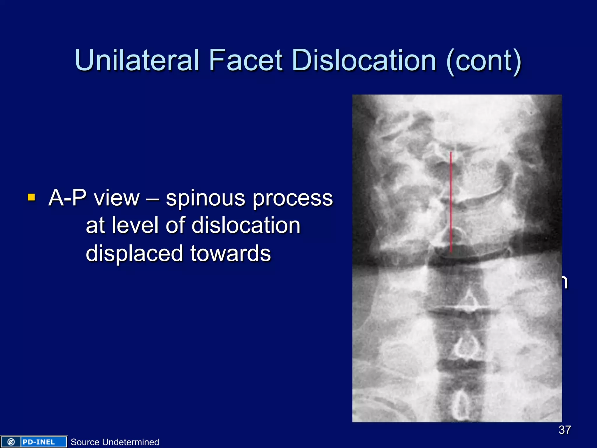 Unilateral Facet Dislocation (cont)
§  A-P view – spinous process
at level of dislocation
displaced towards
side of dislocation
37
Source Undetermined
 