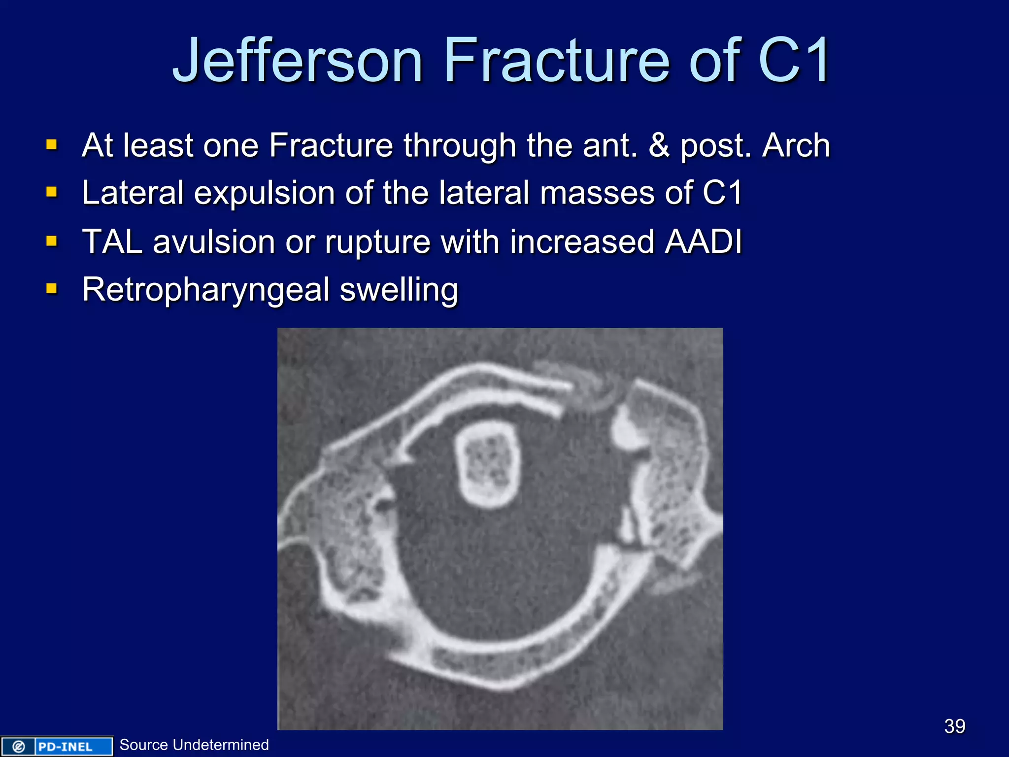 Jefferson Fracture of C1
§  At least one Fracture through the ant. & post. Arch
§  Lateral expulsion of the lateral masses of C1
§  TAL avulsion or rupture with increased AADI
§  Retropharyngeal swelling
39
Source Undetermined
 