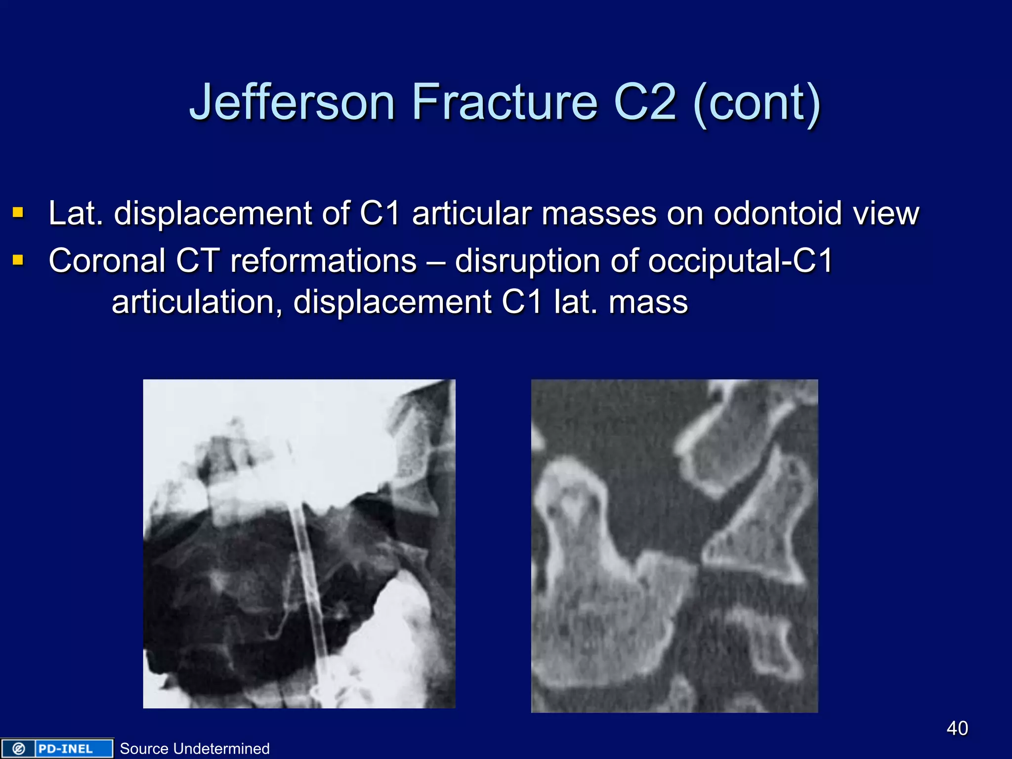 Jefferson Fracture C2 (cont)
§  Lat. displacement of C1 articular masses on odontoid view
§  Coronal CT reformations – disruption of occiputal-C1
articulation, displacement C1 lat. mass
40
Source Undetermined
 