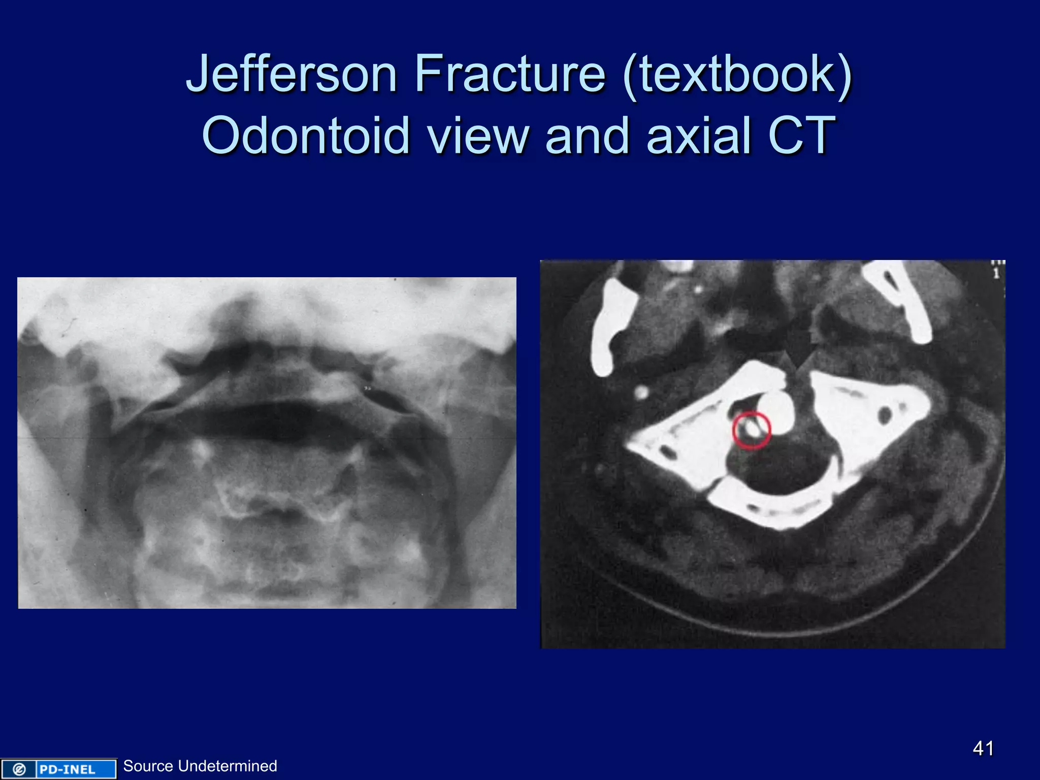 Jefferson Fracture (textbook)
Odontoid view and axial CT
41
Source Undetermined
 