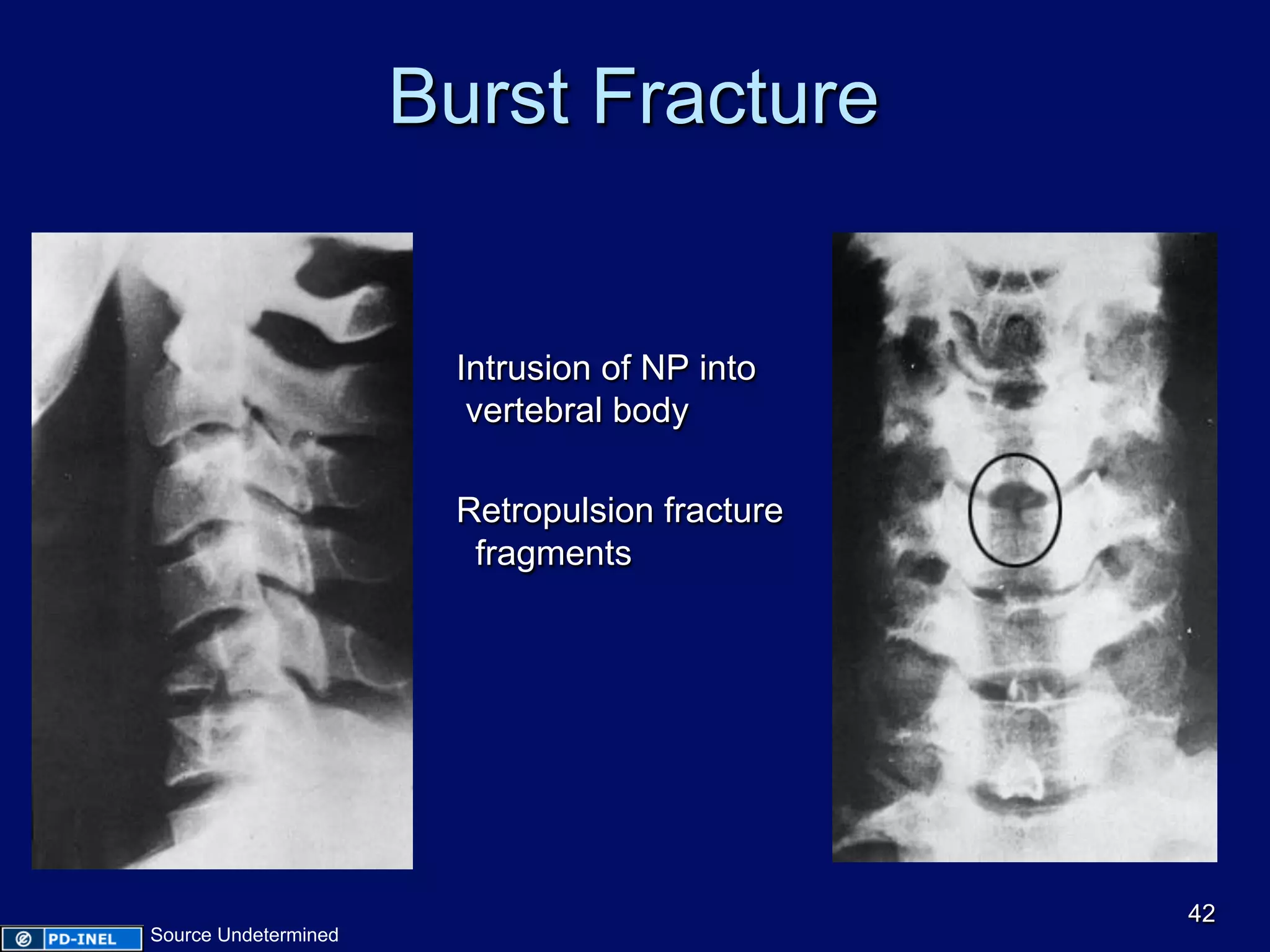 Burst Fracture
Intrusion of NP into
vertebral body
Retropulsion fracture
fragments
Fracture on A-P view
42
Source Undetermined
 