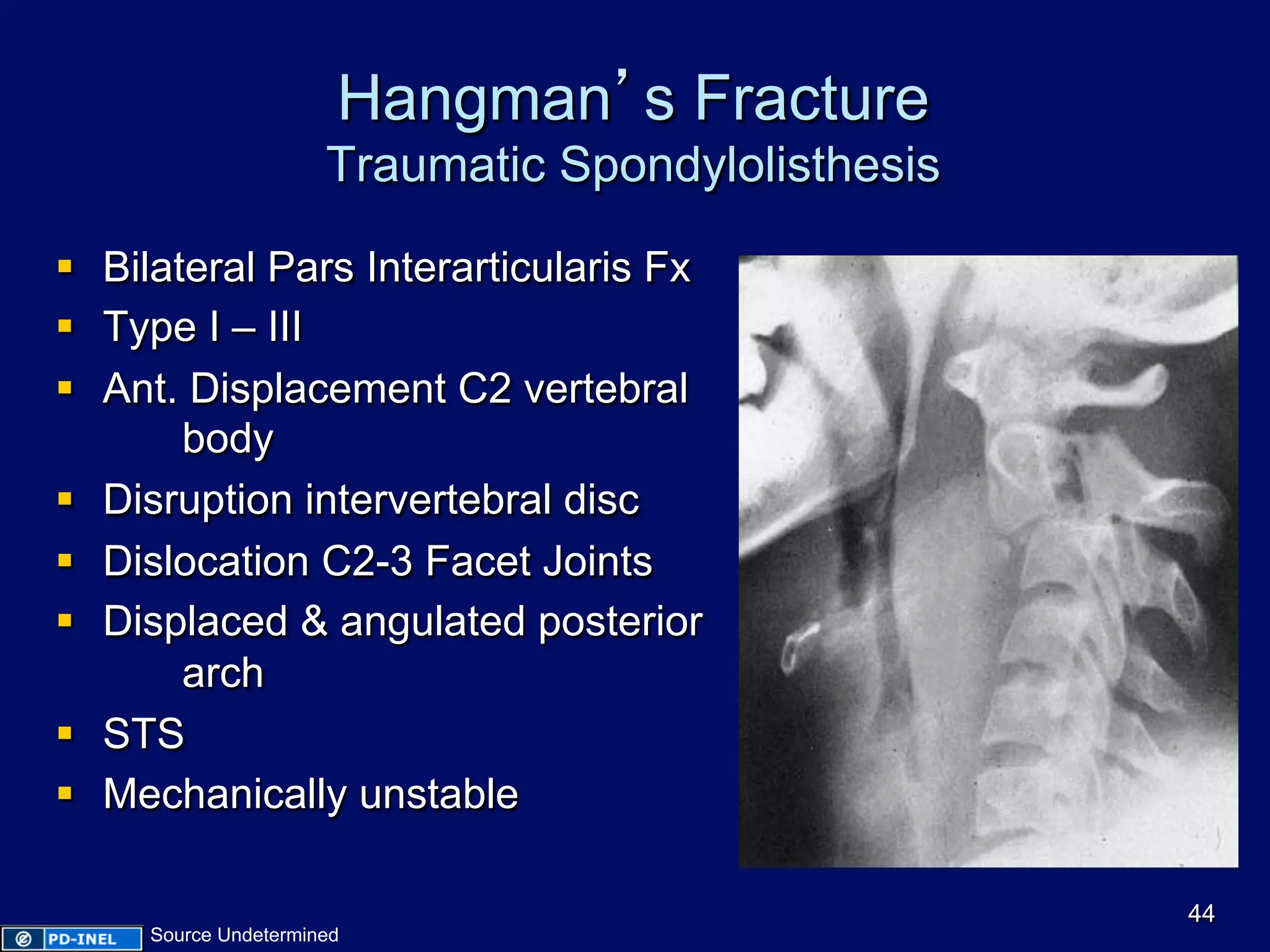 Hangman’s Fracture
Traumatic Spondylolisthesis
§  Bilateral Pars Interarticularis Fx
§  Type I – III
§  Ant. Displacement C2 vertebral
body
§  Disruption intervertebral disc
§  Dislocation C2-3 Facet Joints
§  Displaced & angulated posterior
arch
§  STS
§  Mechanically unstable
44
Source Undetermined
 