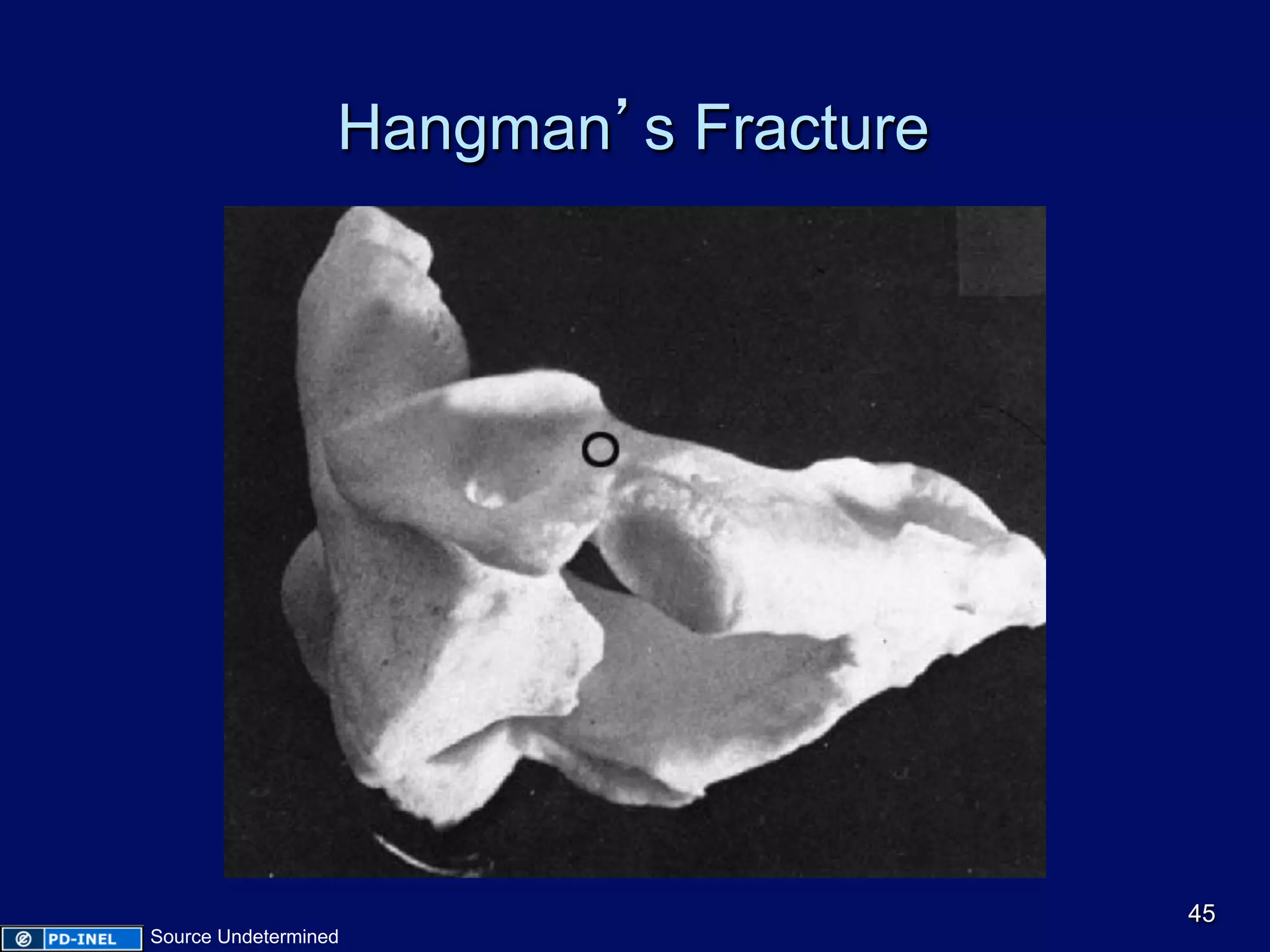 Hangman’s Fracture
45
Source Undetermined
 