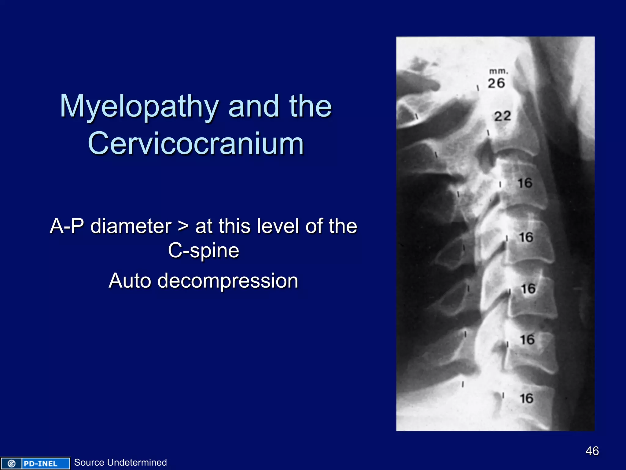 Myelopathy and the
Cervicocranium
A-P diameter > at this level of the
C-spine
Auto decompression
46
Source Undetermined
 